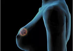 乳腺癌靶向治疗药品——拉帕替尼