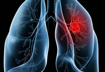 肺癌复发后有哪些症状