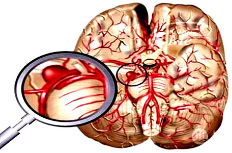 脑海绵状血管瘤有哪些症状特点