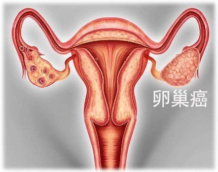 Lynparza（利普卓）联合贝伐单抗一线维持治疗同源重组缺陷（HRD）阳性晚期卵巢癌获欧盟批准！_香港济民药业