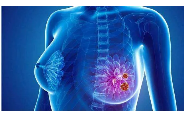 PI3K抑制剂或助于预防乳腺癌与他莫昔芬相关的子宫癌