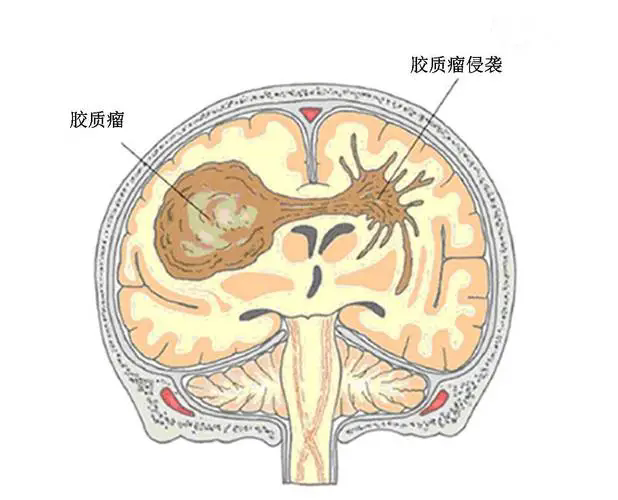 脑胶质瘤