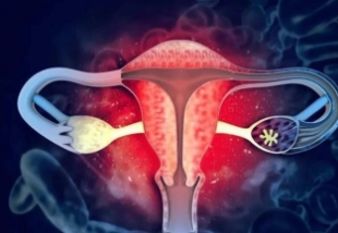 Avutometinib+Defactinib